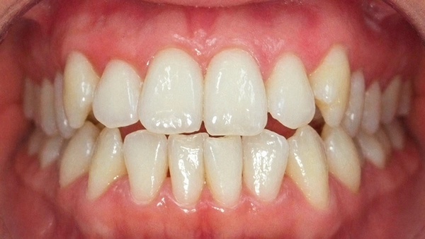 Antes del tratamiento Invisalign: apiñamiento dental y desalineación